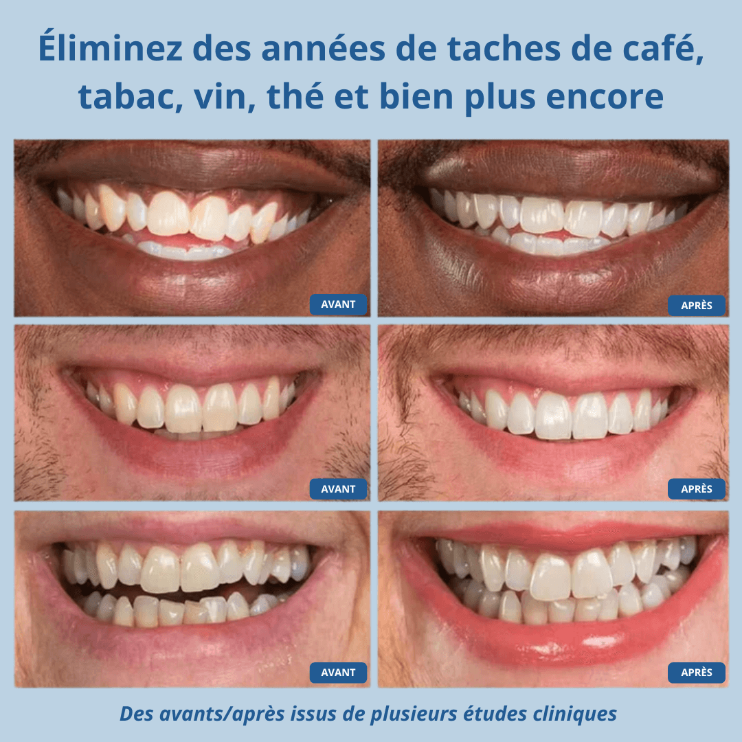 Blanchisseur Dentaire Minnovia™