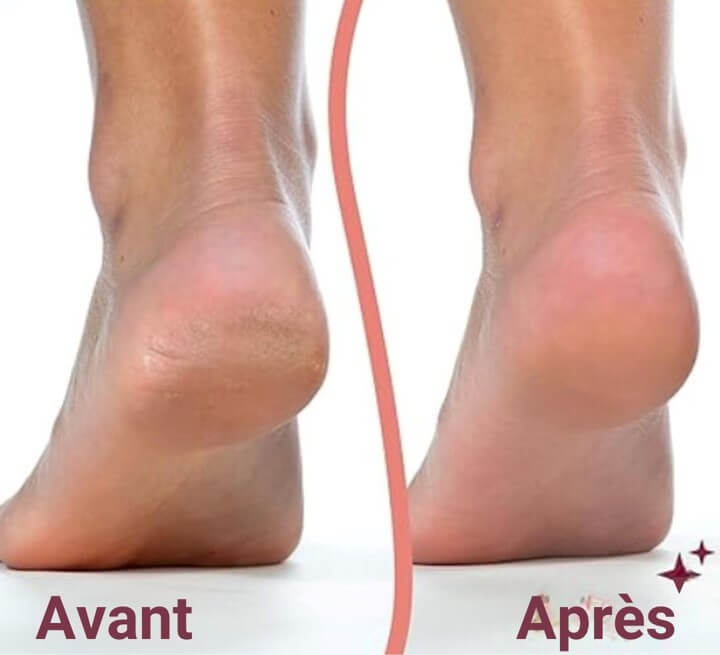 Ponceuse anti-callosité Minnovia™